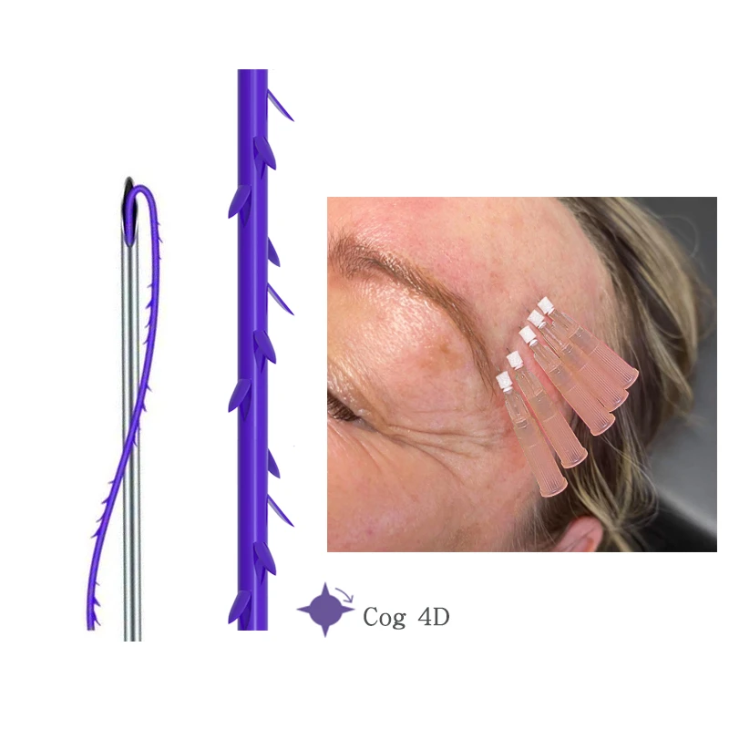 Zahnrad 4D-Gewinde