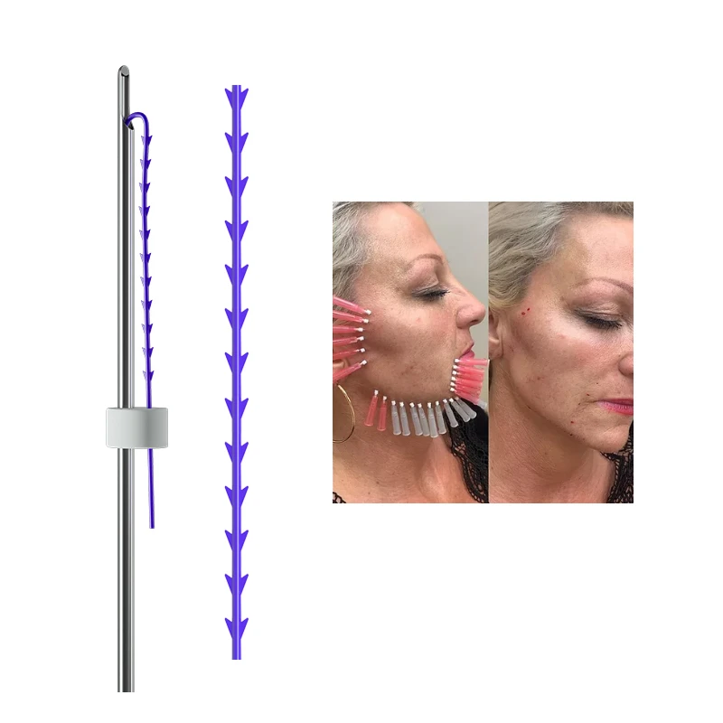 Kegel-Zahnrad-Gewinde