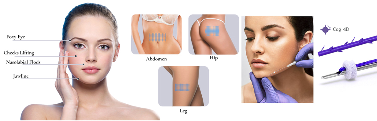 PDO Cog 4D Facial Lift: Erweitertes Fadenlifting für die Kieferkonturierung